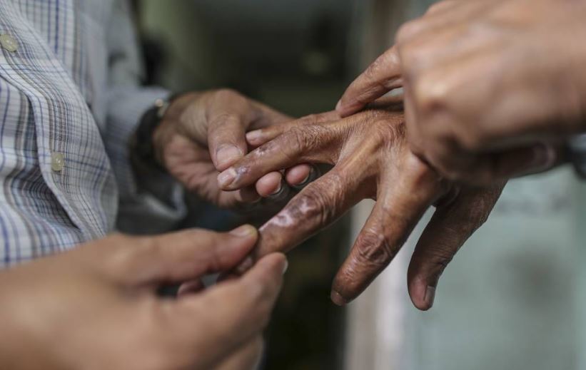 कुष्ठरोग निवारणमा गण्डकी प्रदेश पहिलो