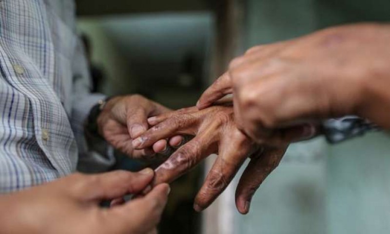 कुष्ठरोग उपचारमा वाग्मती प्रदेशमा ललितपुर पहिलो