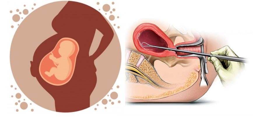 डोटीमा एघार महिनामा एक हजारले गरे गर्भपतन