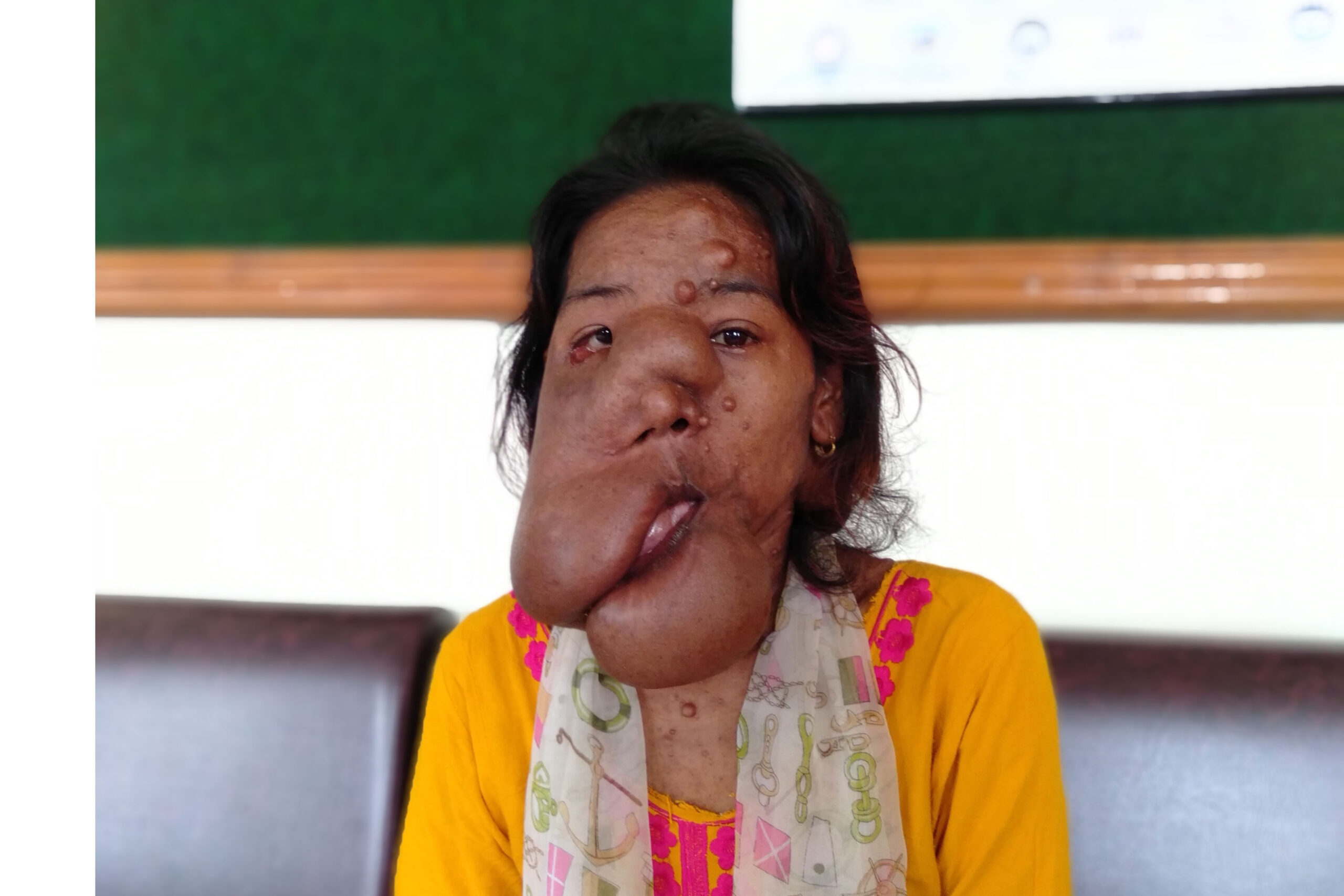 मासुको डल्लो पलाएर अनुहार छोपियो, उपचार पाइएन